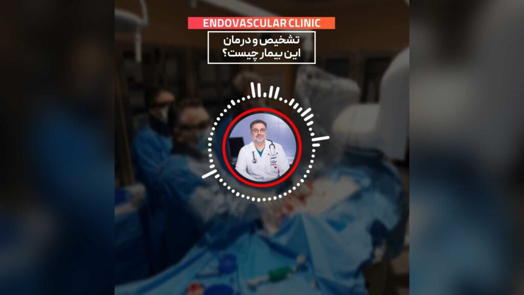 درمان تنگی دو طرفه عروق گردن با استفاده از فیلتر و استنت