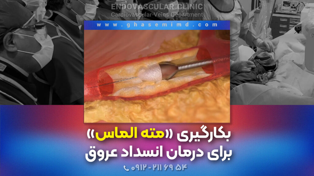 بکارگیری مته الماس برای درمان انسداد عروق