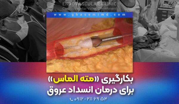 بکارگیری مته الماس برای درمان انسداد عروق